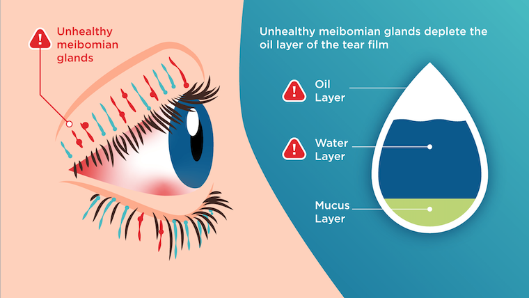 Diagram of MGD, a cause of Dry Eye Syndrome.